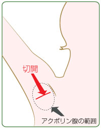 アクポリン腺の切除